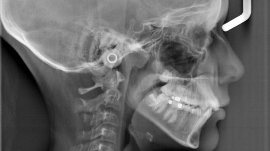 Opg Lateral Cephalogram